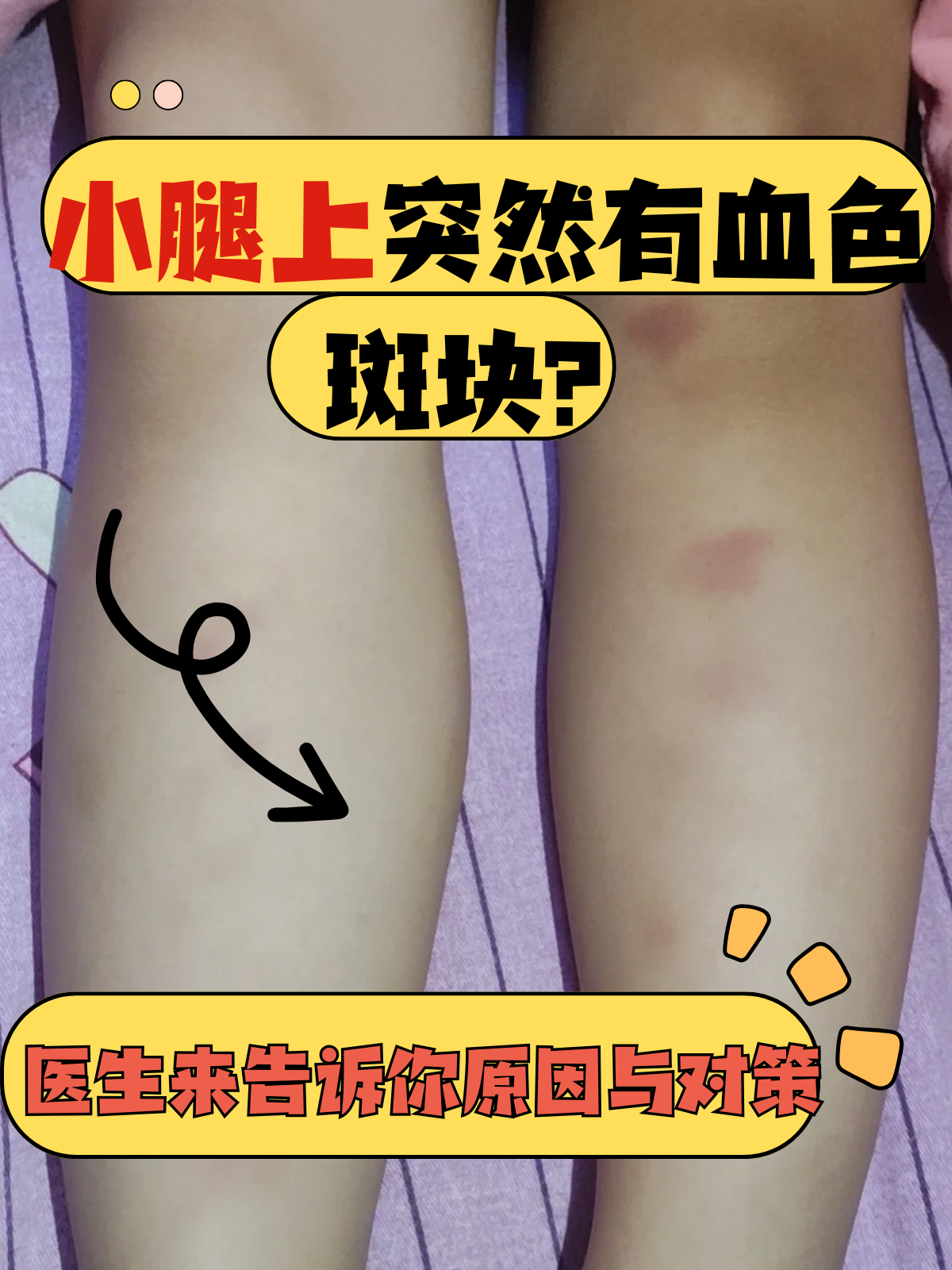 医生来告诉你原因与对策 小腿上突然出现的血色斑块是一个让很多朋友