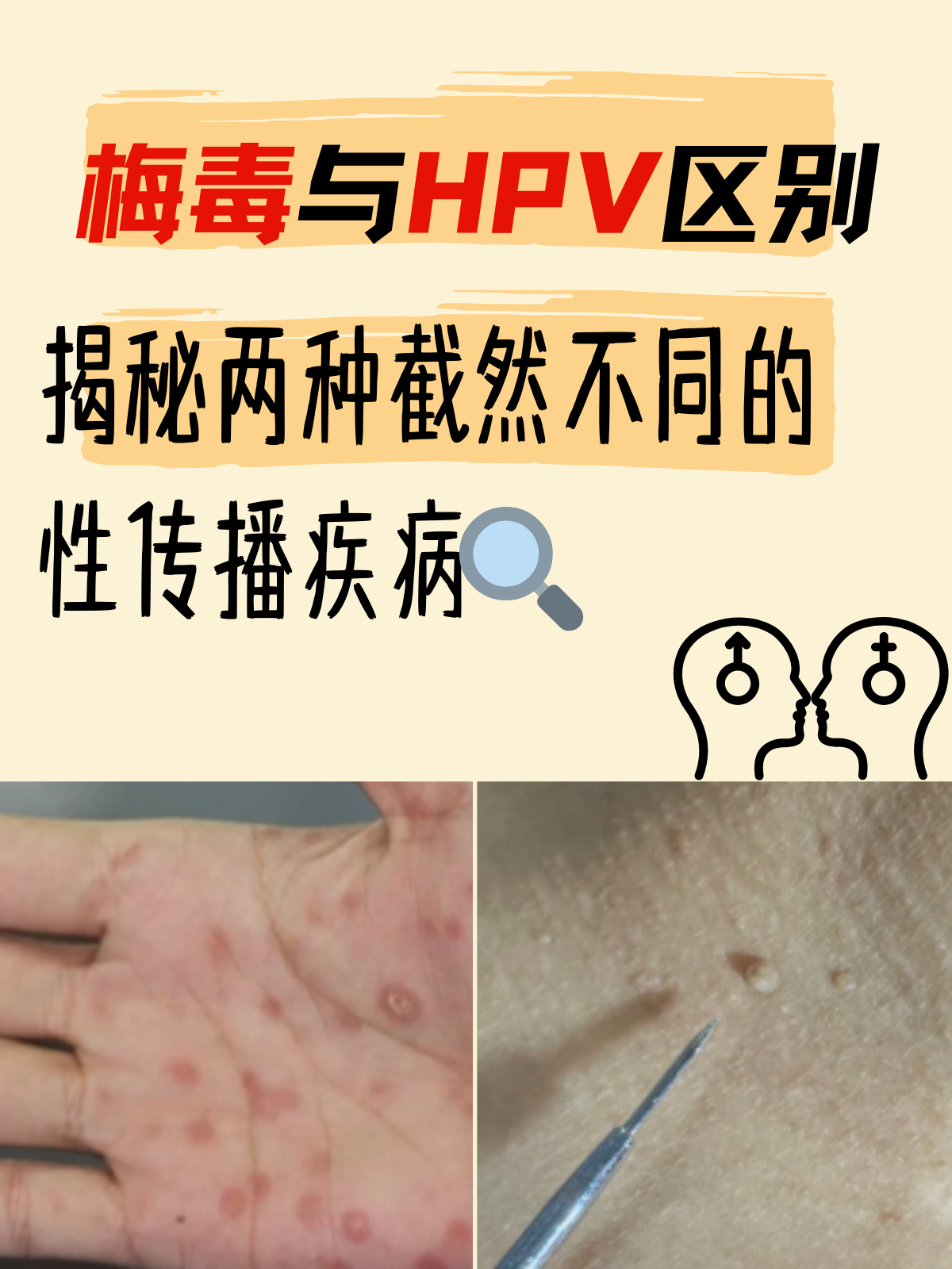 梅毒与hpv区别:揭秘两种截然不同的性传播疾病 在临