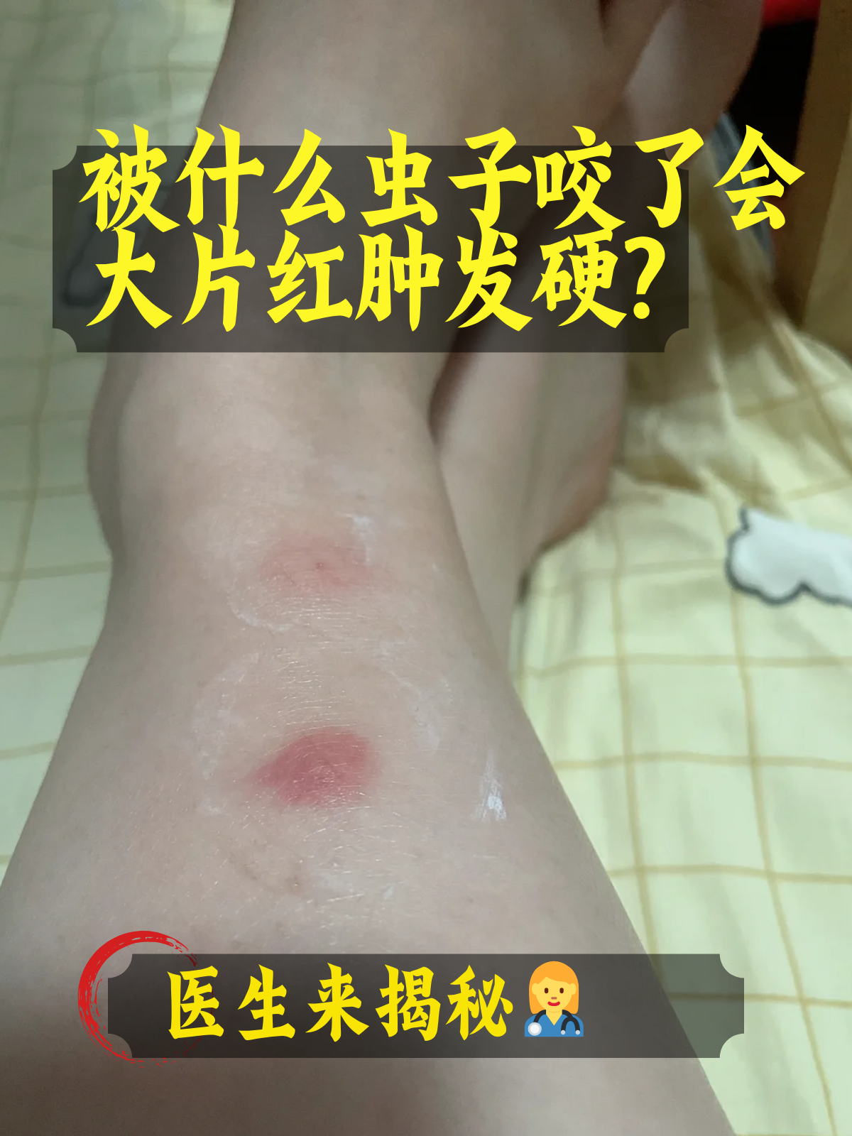 被这些各种虫咬对照图片20种常见虫咬的图片被虫子咬了红肿很硬痒
