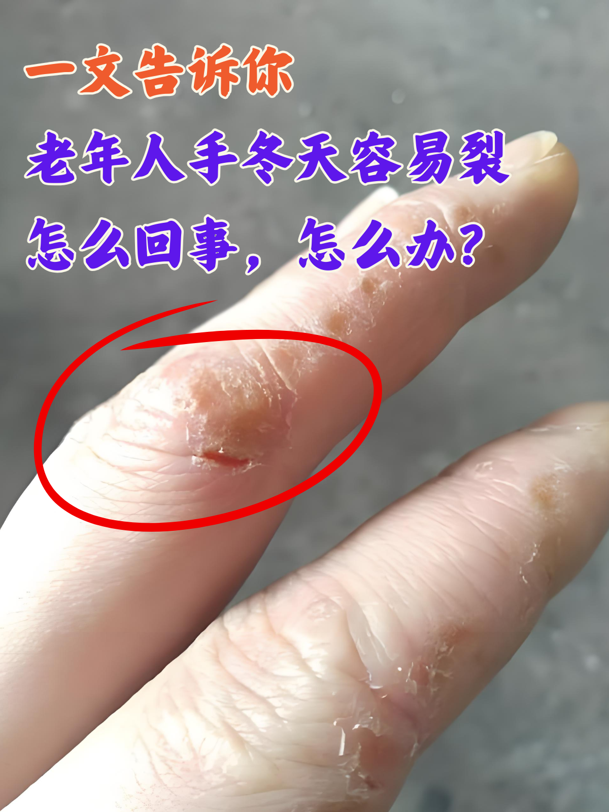 随着冬季的来临,许多老年人会发现自己的手部皮肤变得干燥,粗糙,甚至