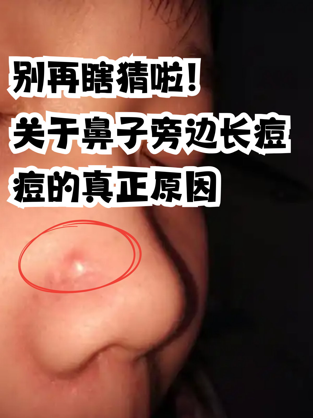 关于鼻子旁边长痘痘的真正原因 照镜子的时候,突然发现鼻子旁边冒出了