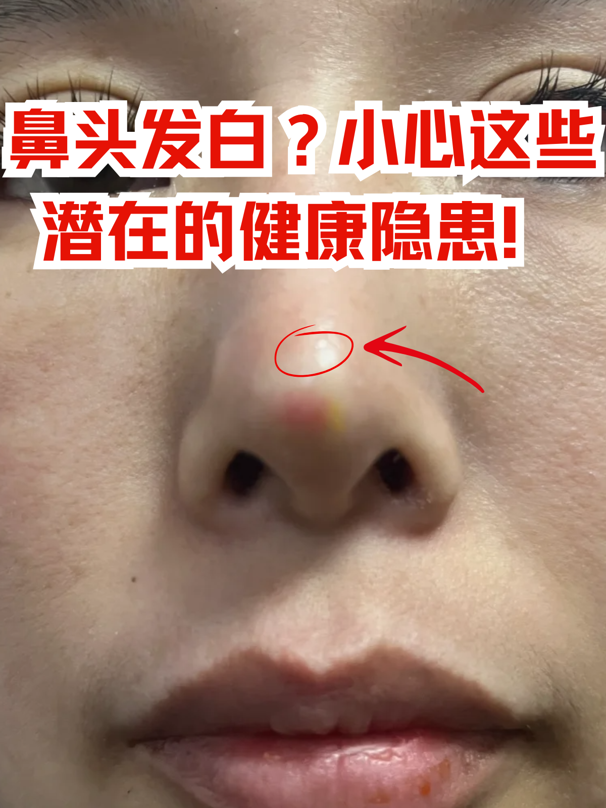 身体为了限制热量散发鼻头发白鼻头苍白艾滋病鼻子症状有哪些鼻梁发白