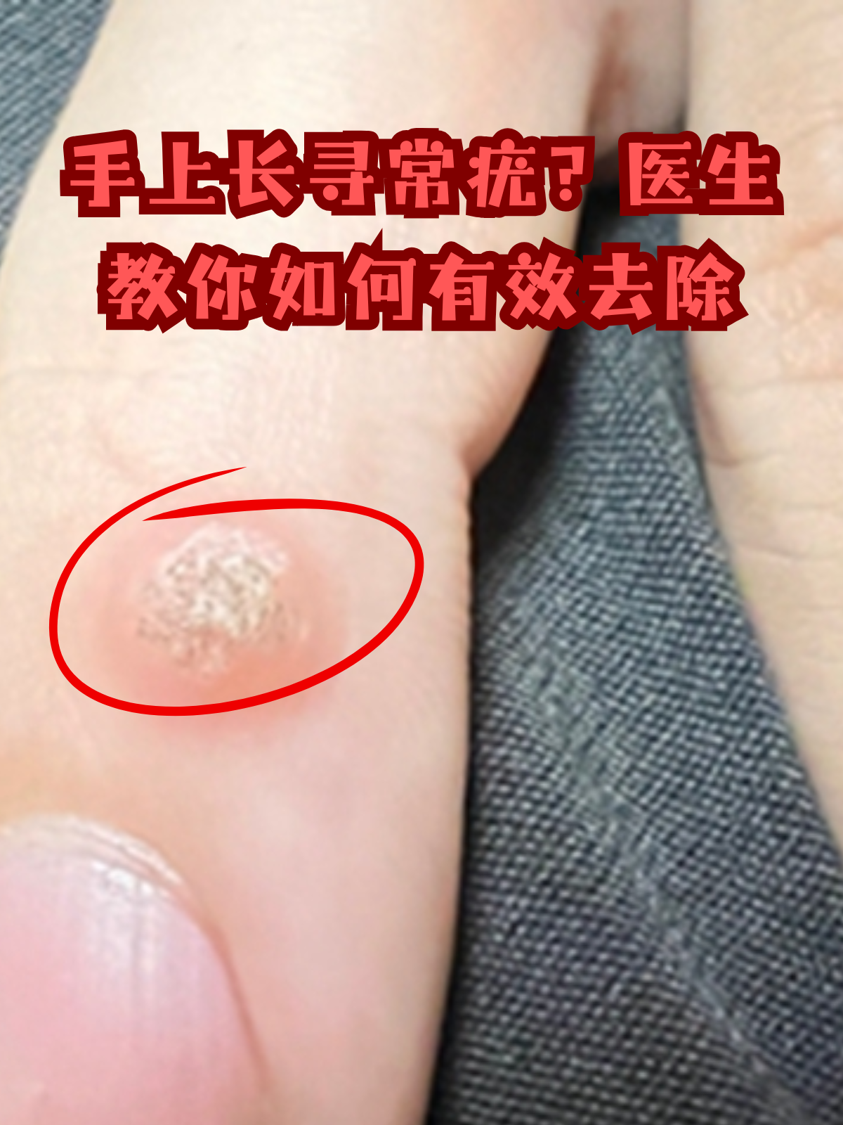 手上长寻常疣?