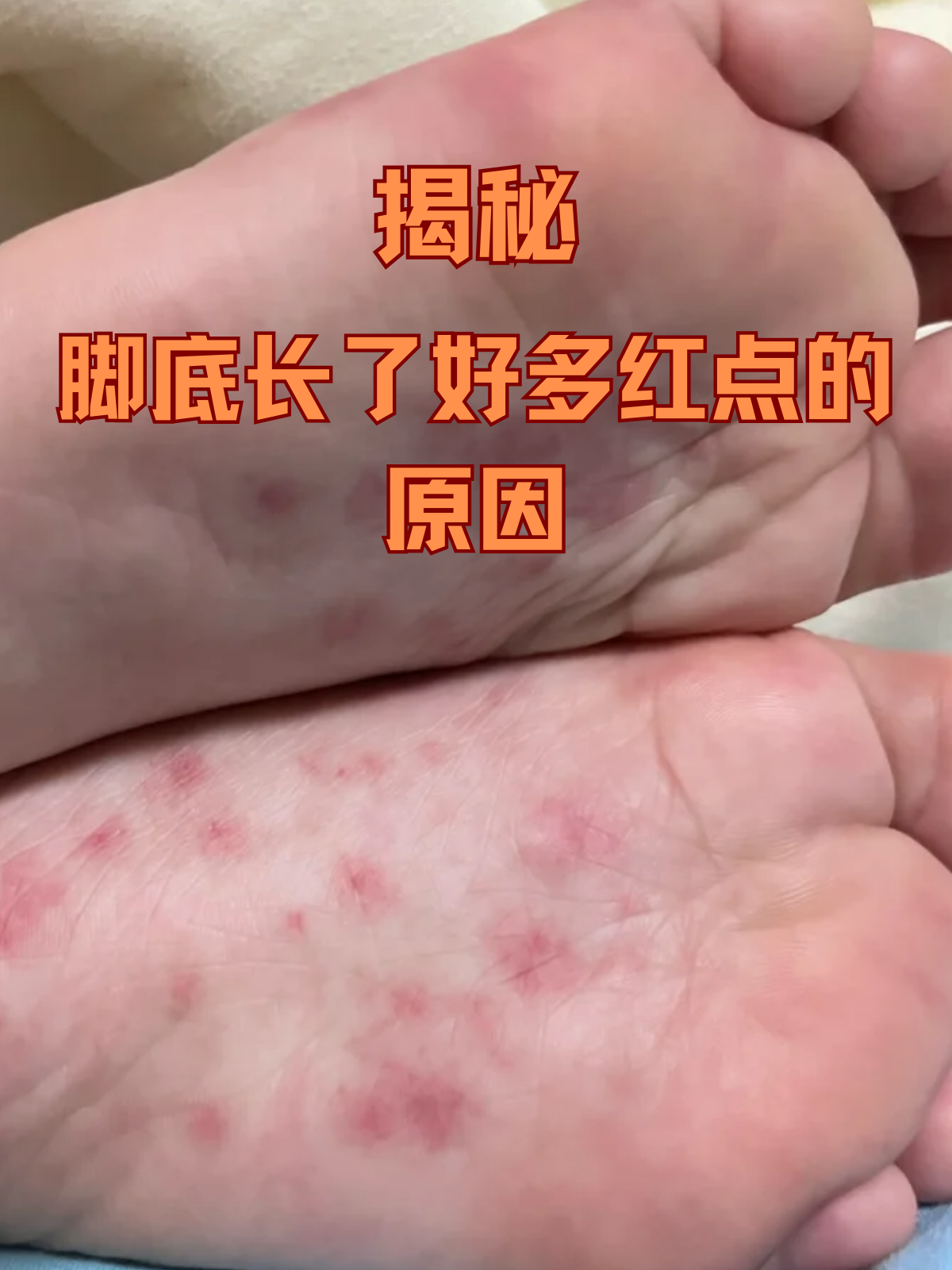 脚底长红点可能是以下原因引起