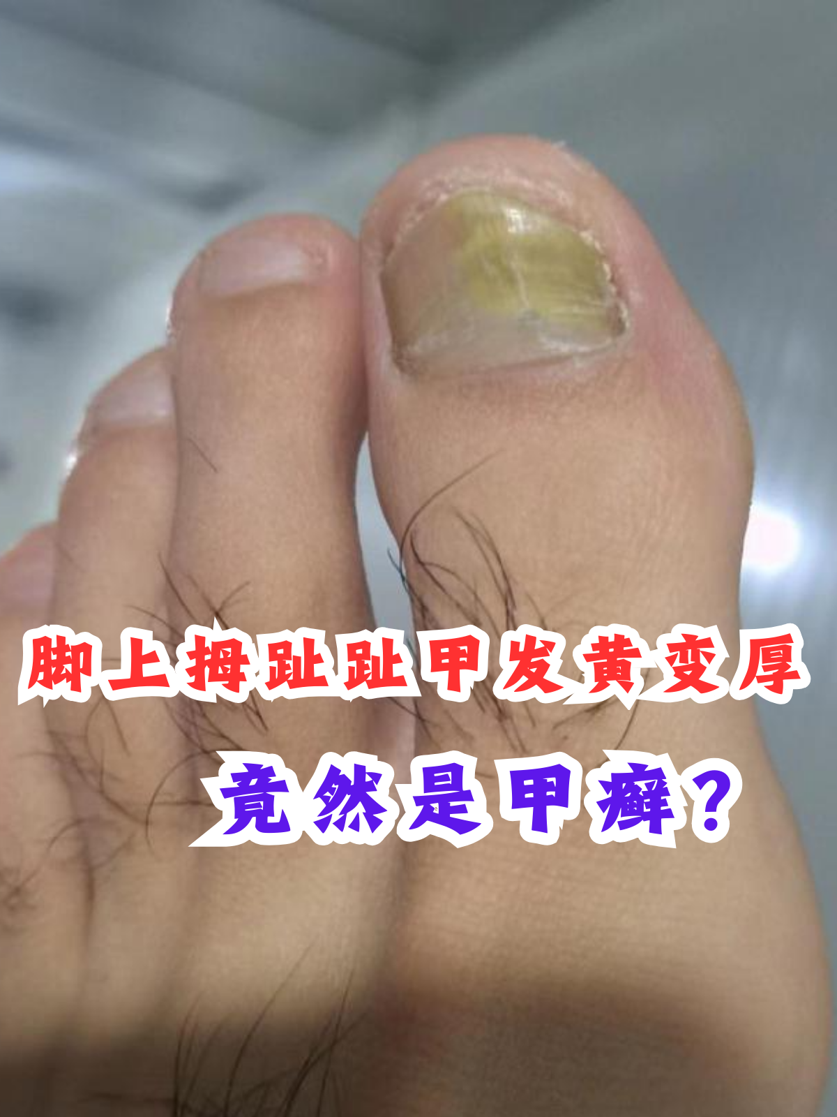 脚上拇趾趾甲发黄变厚,竟然是甲癣?