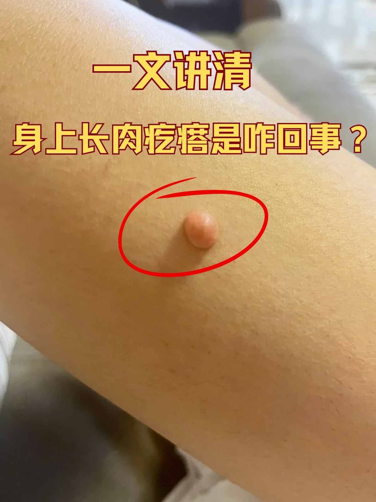 精心挑选了美美的衣服,满心欢喜时,却发现身上居然长出个肉疙瘩!