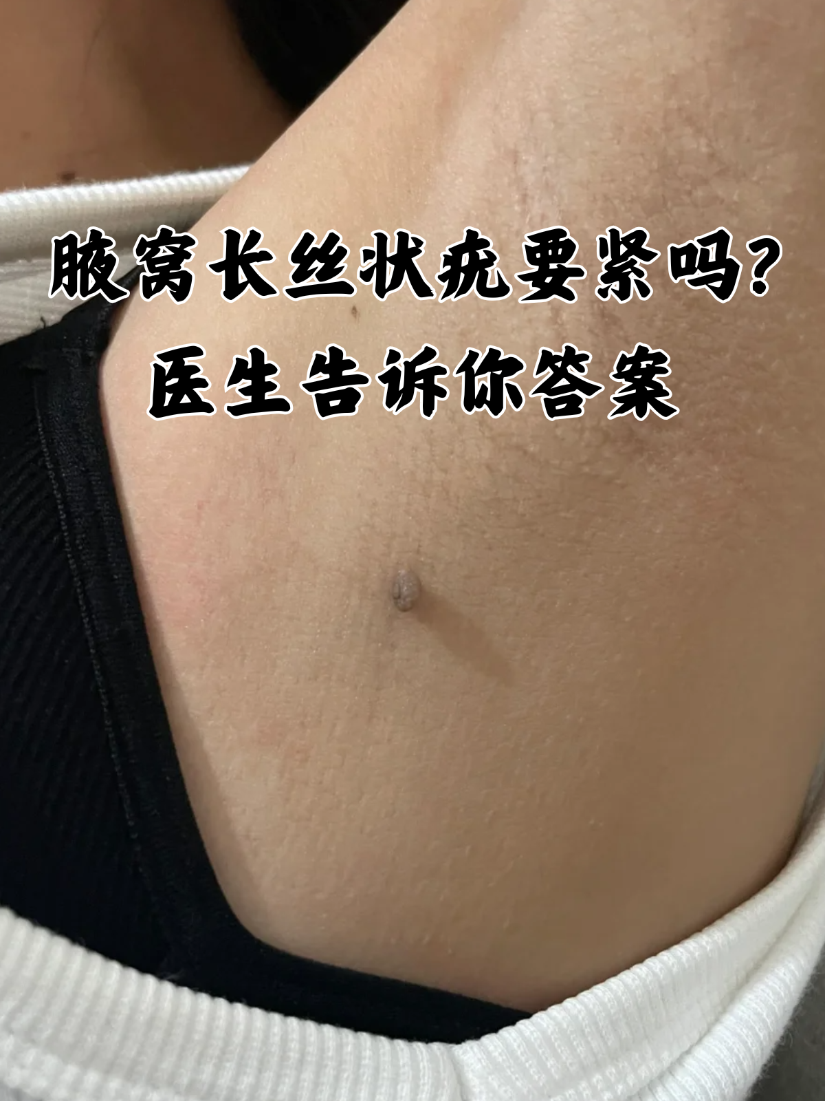 医生告诉你答案 丝状疣是一种常见的皮肤疾病,可能导致眼睑,脖子,腋窝