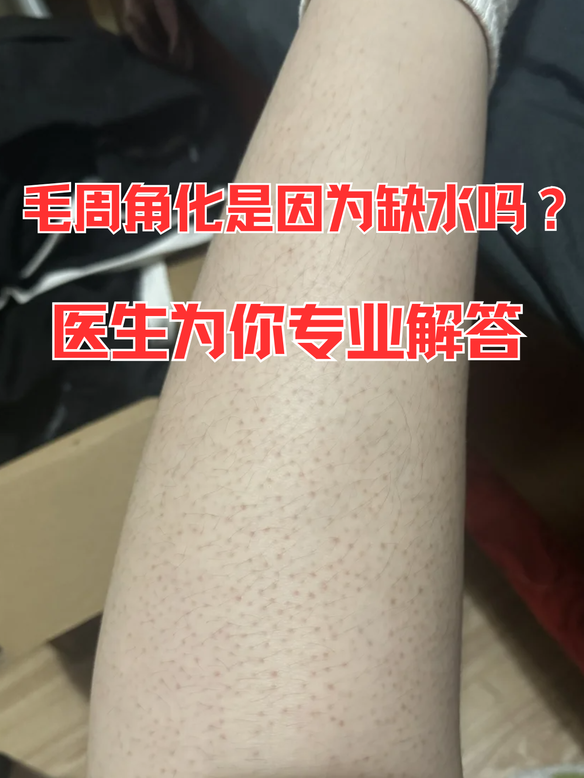 毛周角化是因为缺水吗?