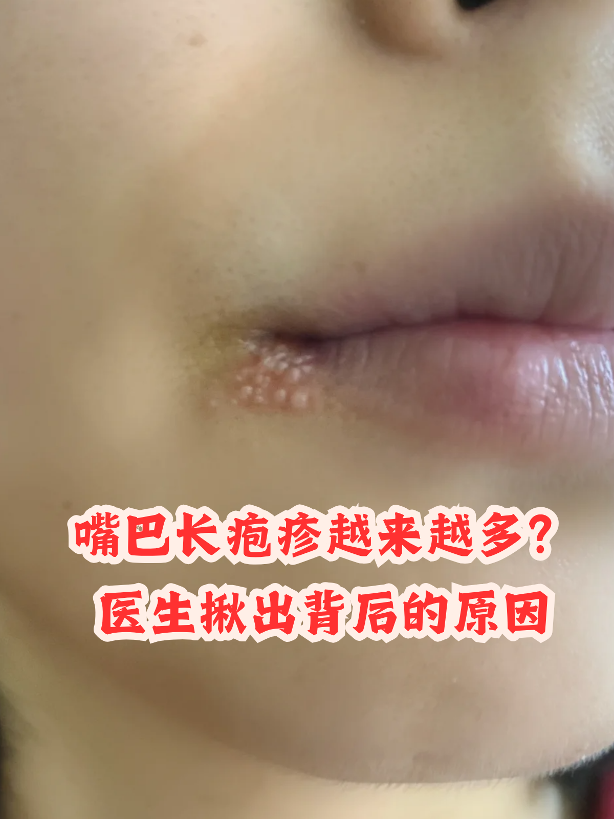 疱疹复发6次要警惕了为什么在线