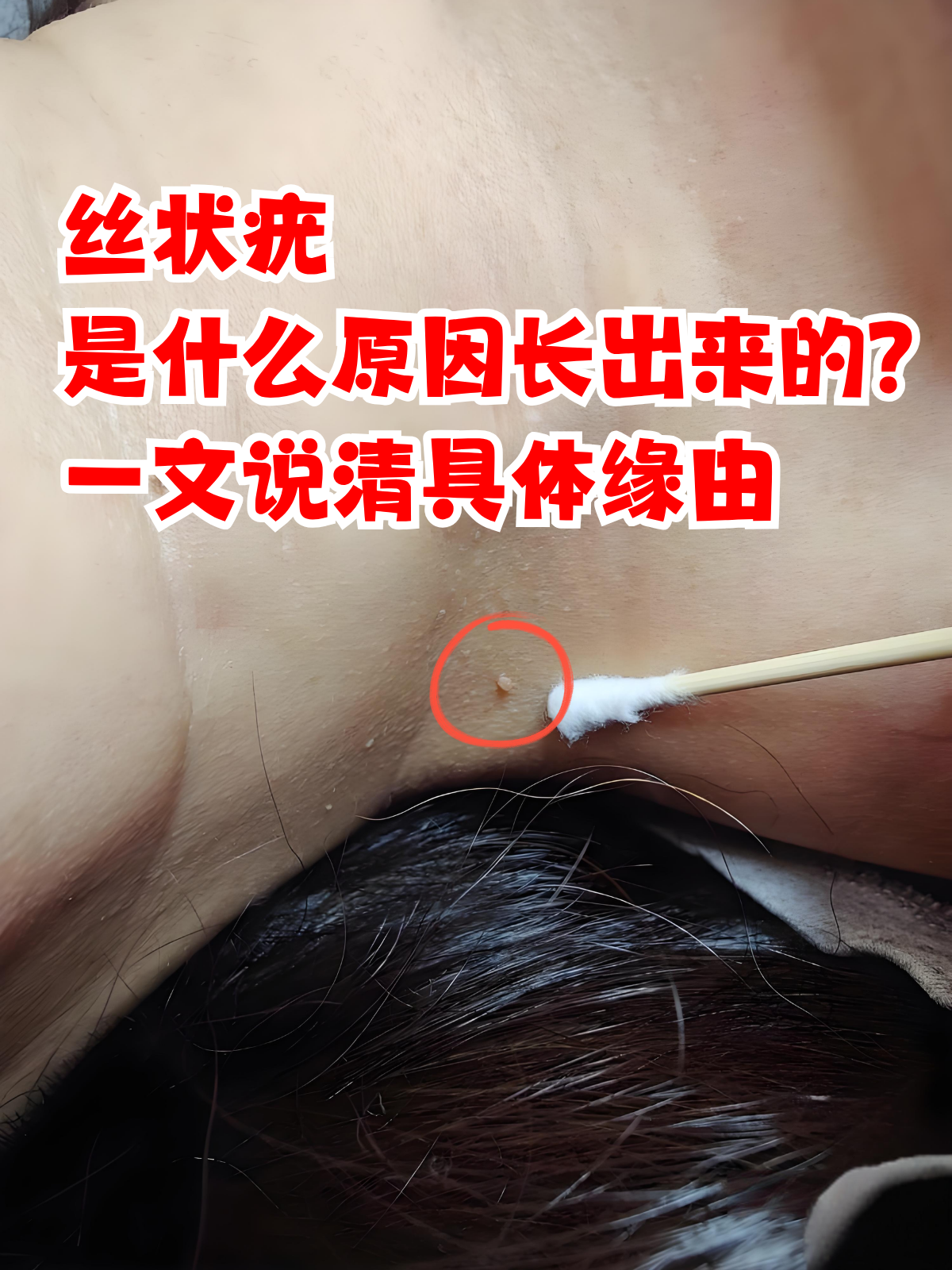 丝状疣是什么原因长出来的?
