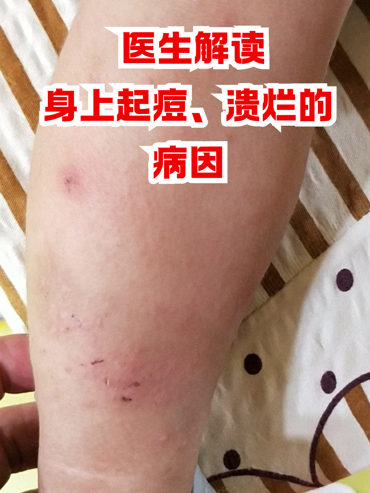 溃烂的病因 如果某天突然发现身上冒出痘痘,皮肤还溃烂了,这画面想想