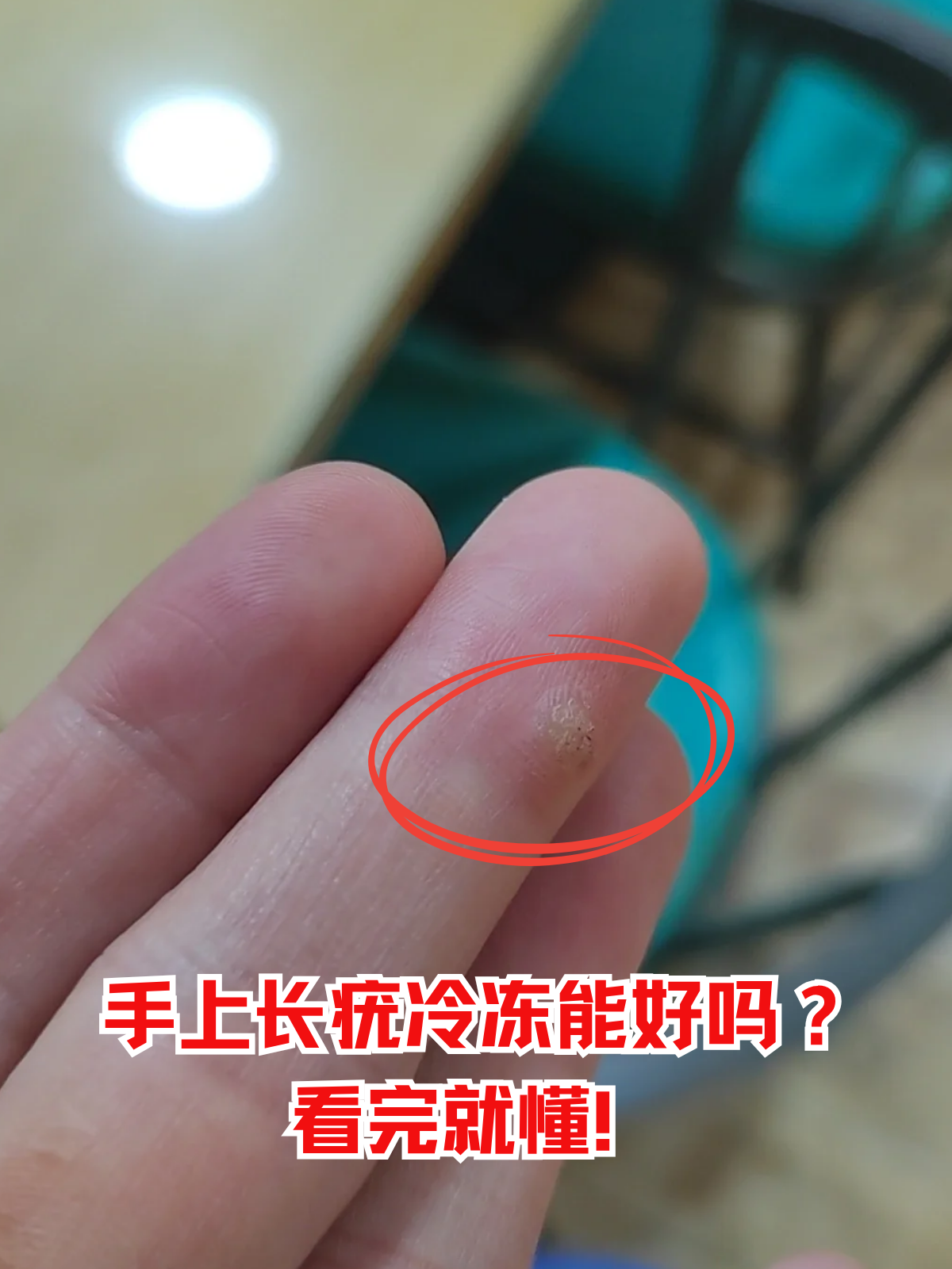 手上长疣冷冻能好吗?看完就懂!