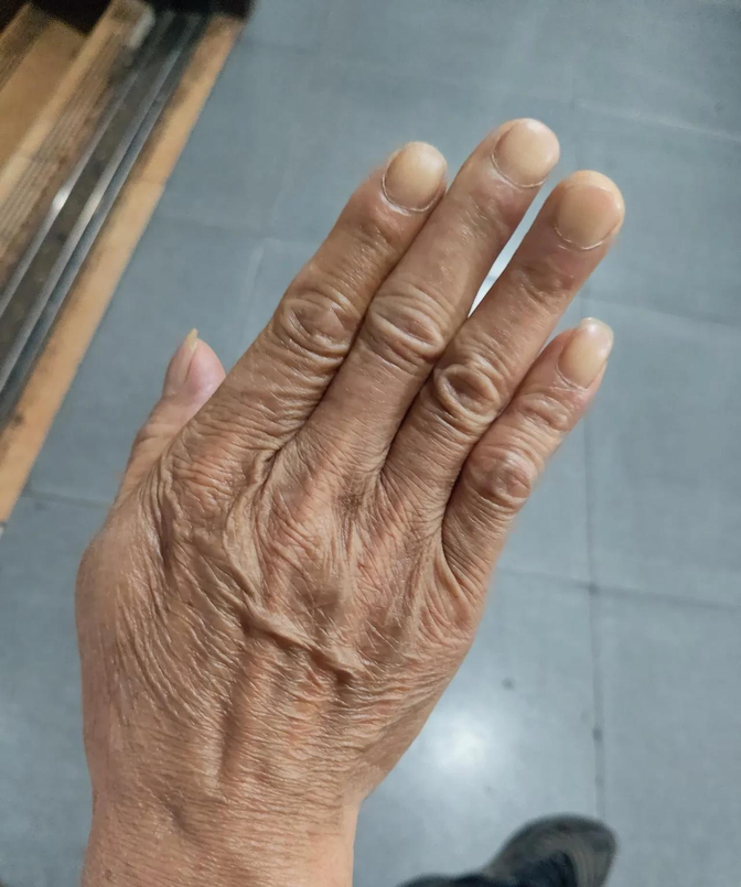 我的公公,今年69岁的一个老人,不知道什么原因,去年开始双手不管做