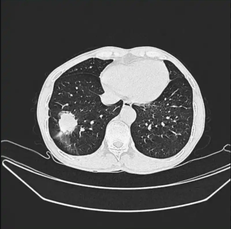 双肺纹理增多 影像显示肺部血管和支气管纹理较正常更为密集,可能与