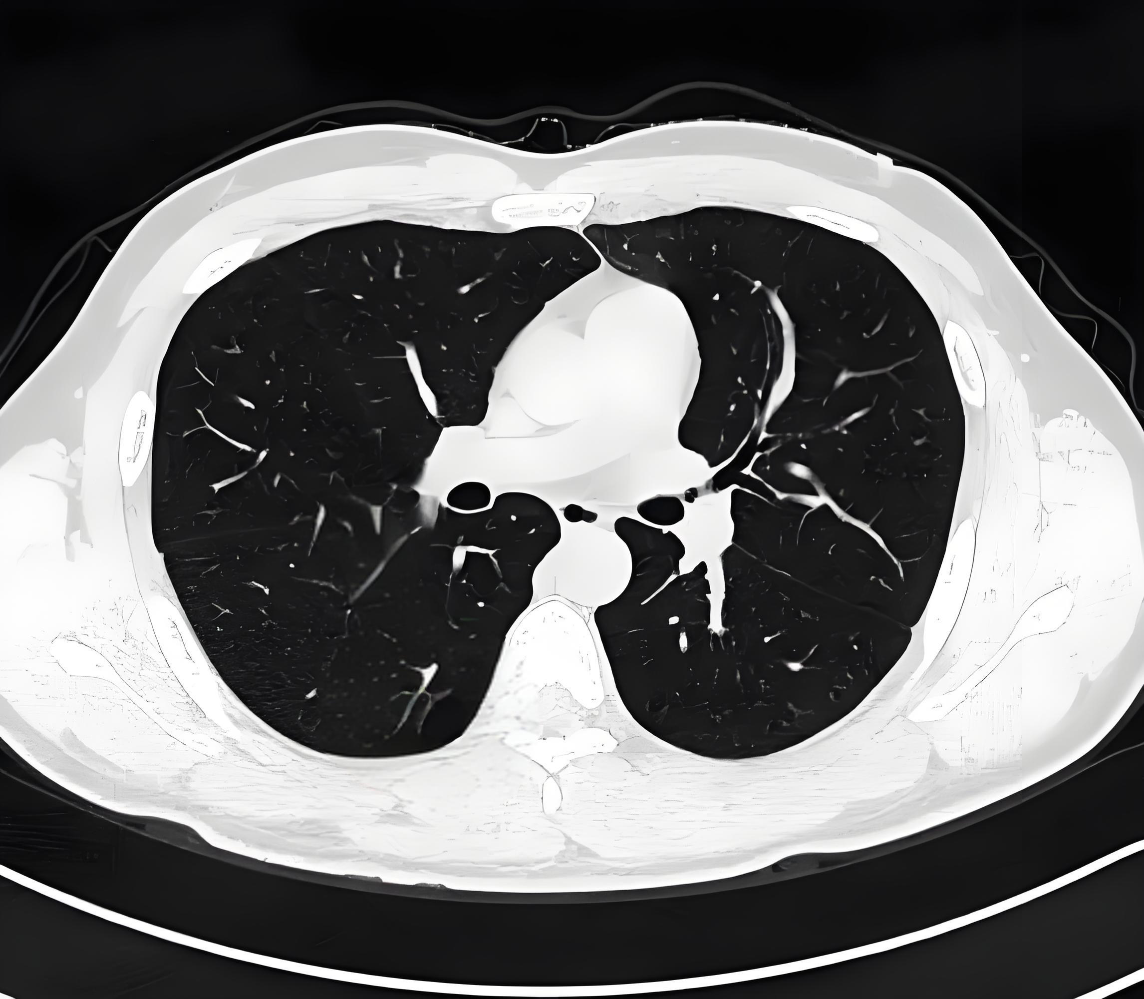 肺ct报告有这 4 个描述,可放宽心!基本没什么风险