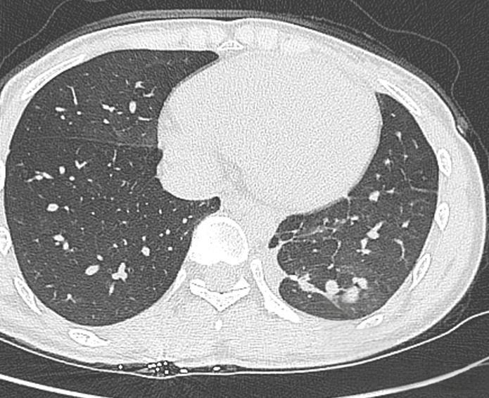 1,纹理增粗 肺部纹理增粗往往提示支气管及其周围组织存在慢性炎症