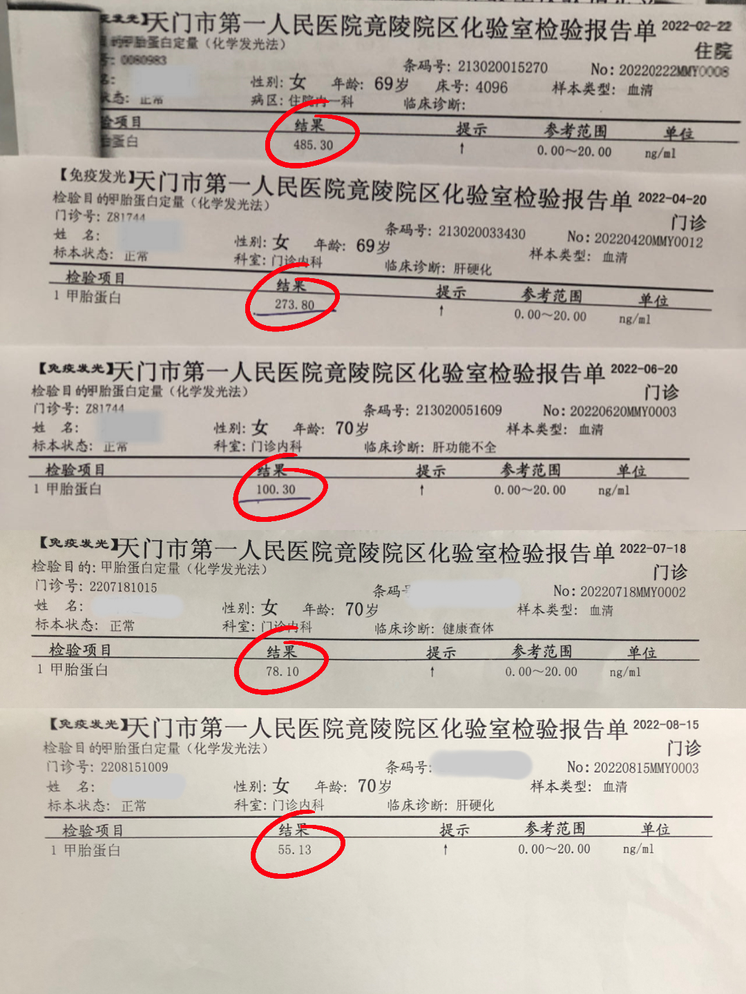 这位70岁的老太太,被查出乙肝,丙肝,肝硬化伴有腹水