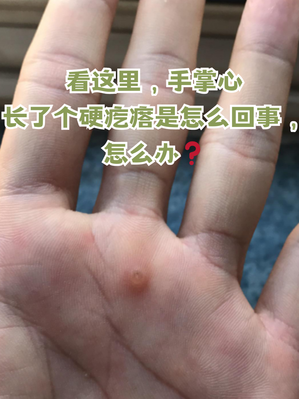 看这里,手掌心长了个硬疙瘩是怎么回事,怎么办71 你有没有遇到过