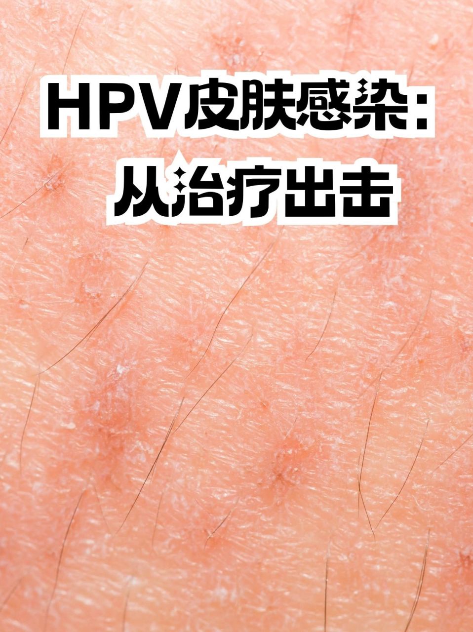 hpv皮肤感染:从治疗出击94 近年来,hpv(人乳头瘤病毒)感染问题日益