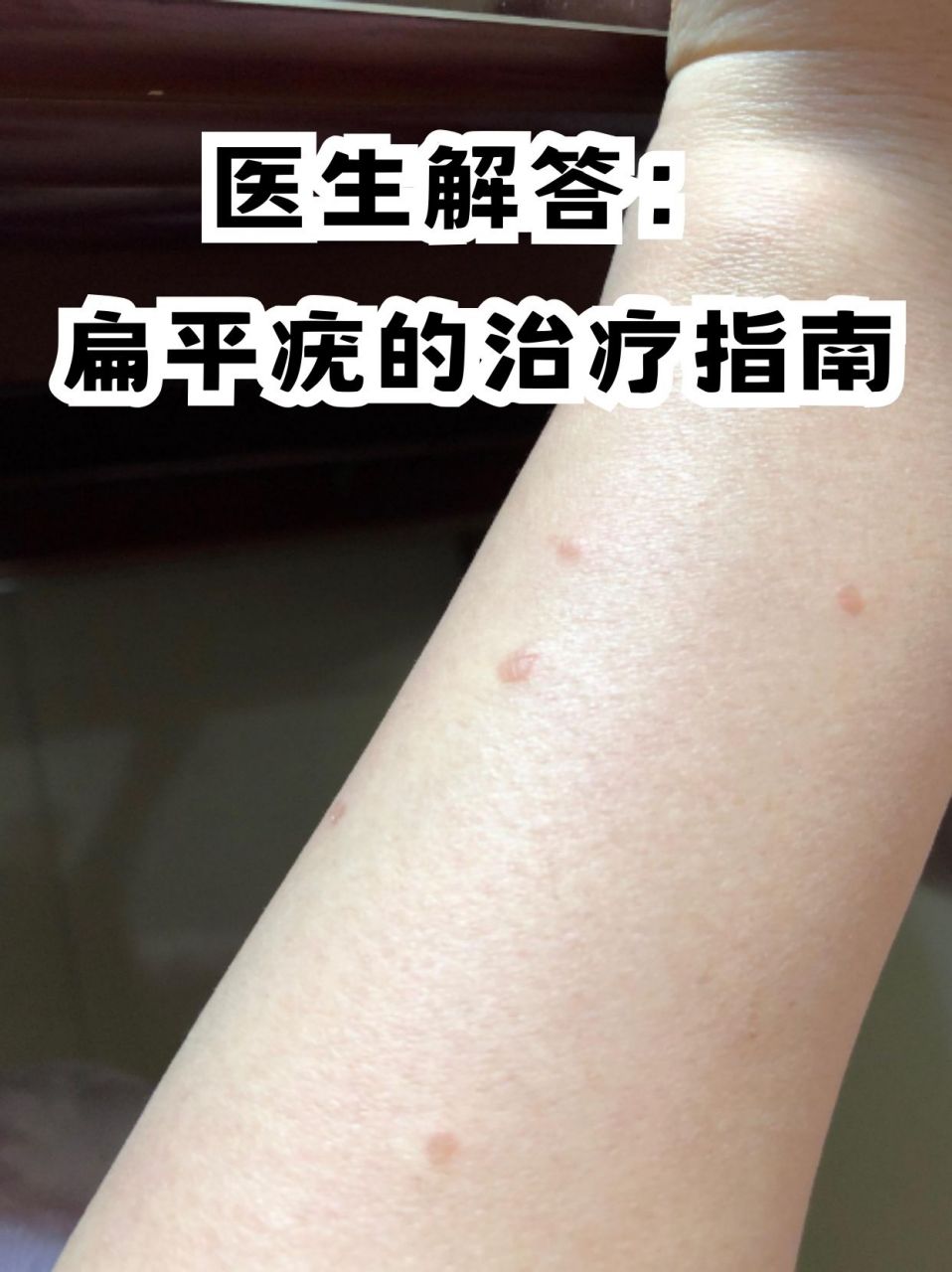 医生解答:扁平疣的治疗指南 扁平疣,这个听起来或许有些陌生的词汇