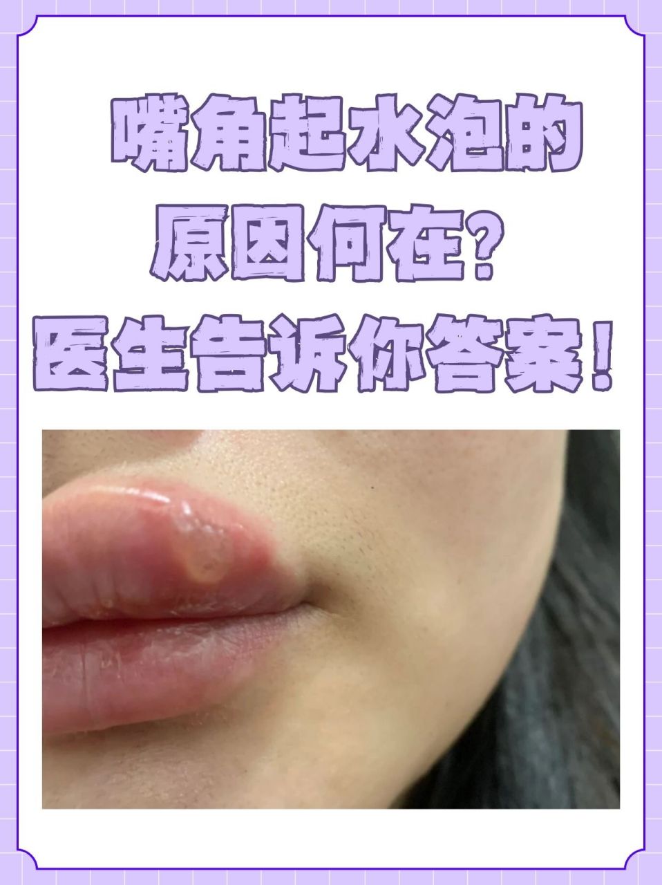 嘴角起水泡,这种看似不大的问题,却常常给我们的日常生活带来诸多