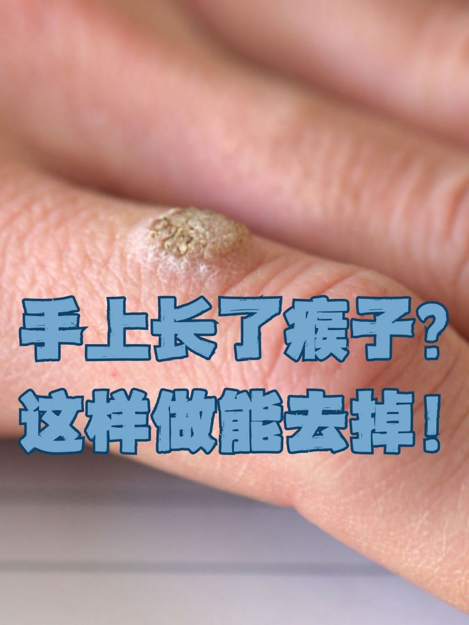 要注意了哟朋友们,它可能就是传说中的"瘊子"(寻常疣).