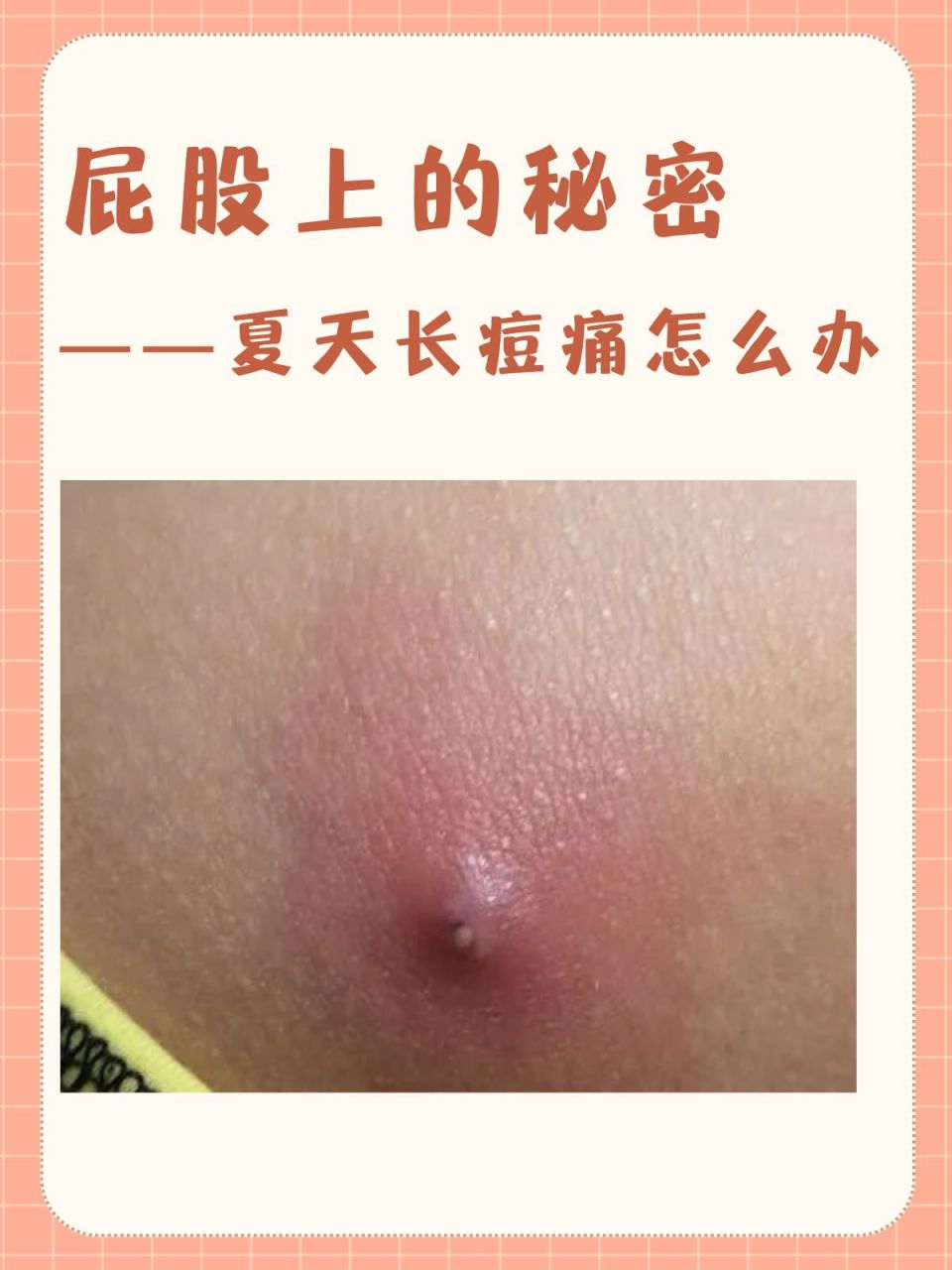 99为什么夏天屁股爱长痘