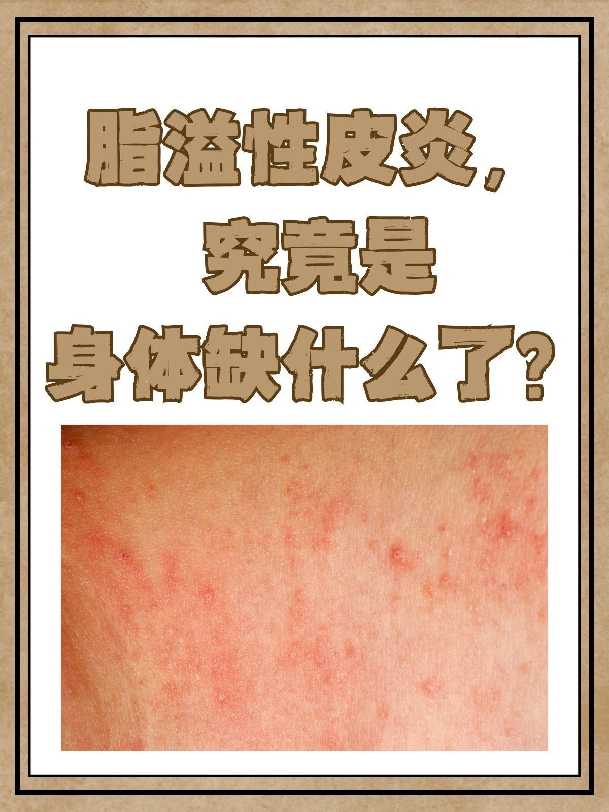 为什么会得脂溢性皮炎