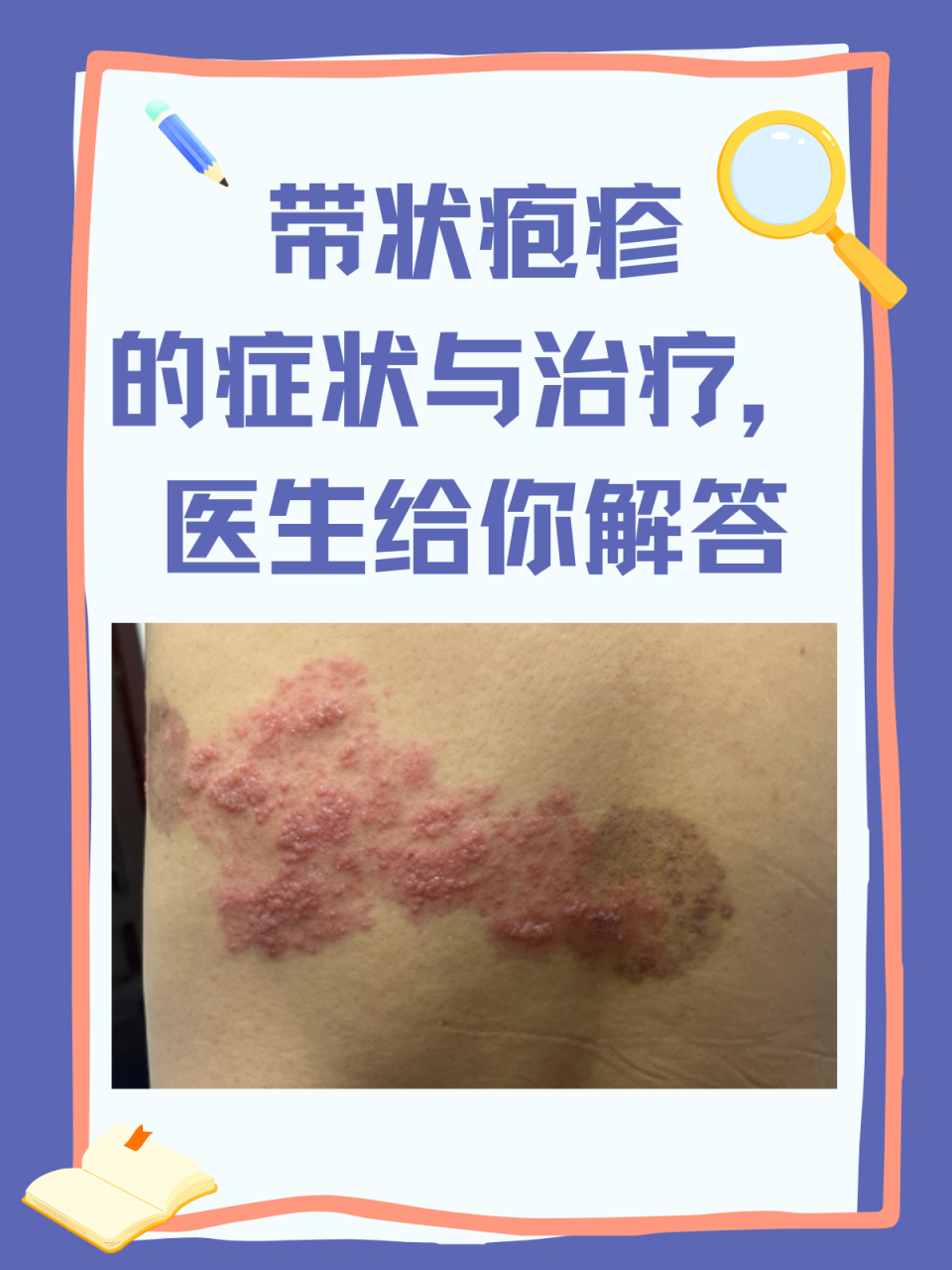 带状疱疹的症状与治疗,医生给你解答 今天我们来聊聊一种既让人头疼又