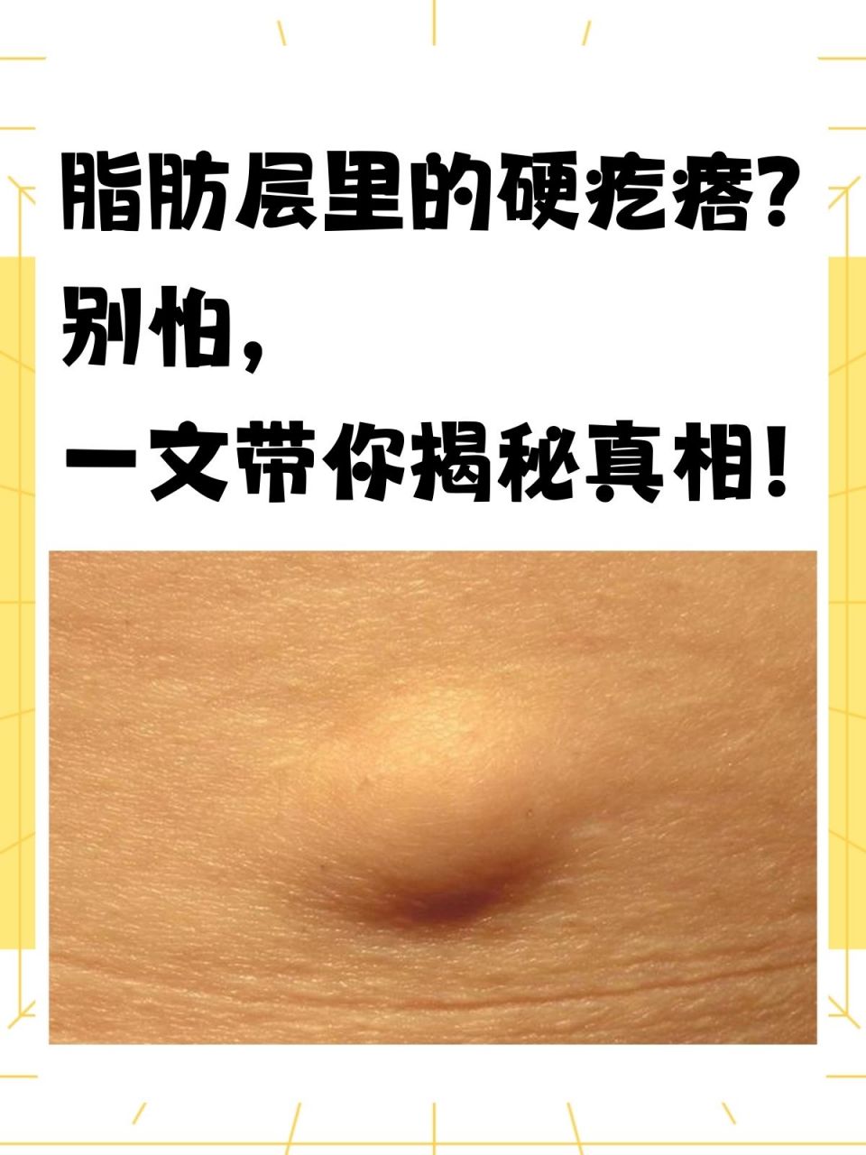 93我们柔软的肌肤之下,脂肪层为身体提供着保护与支持.