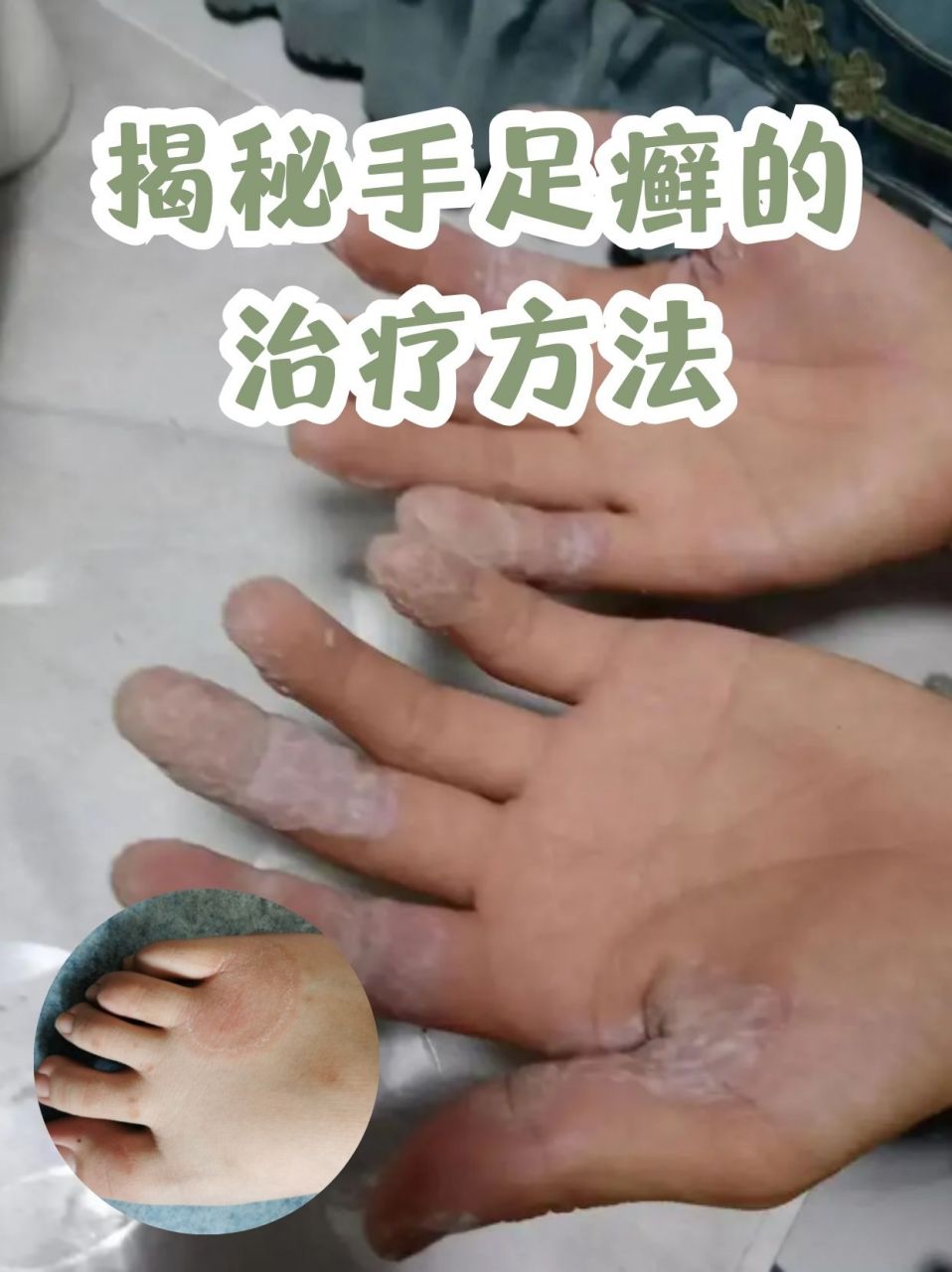 手足癣是由真菌感染引起的皮肤疾病,通常出现在手脚的皮肤上,伴随着