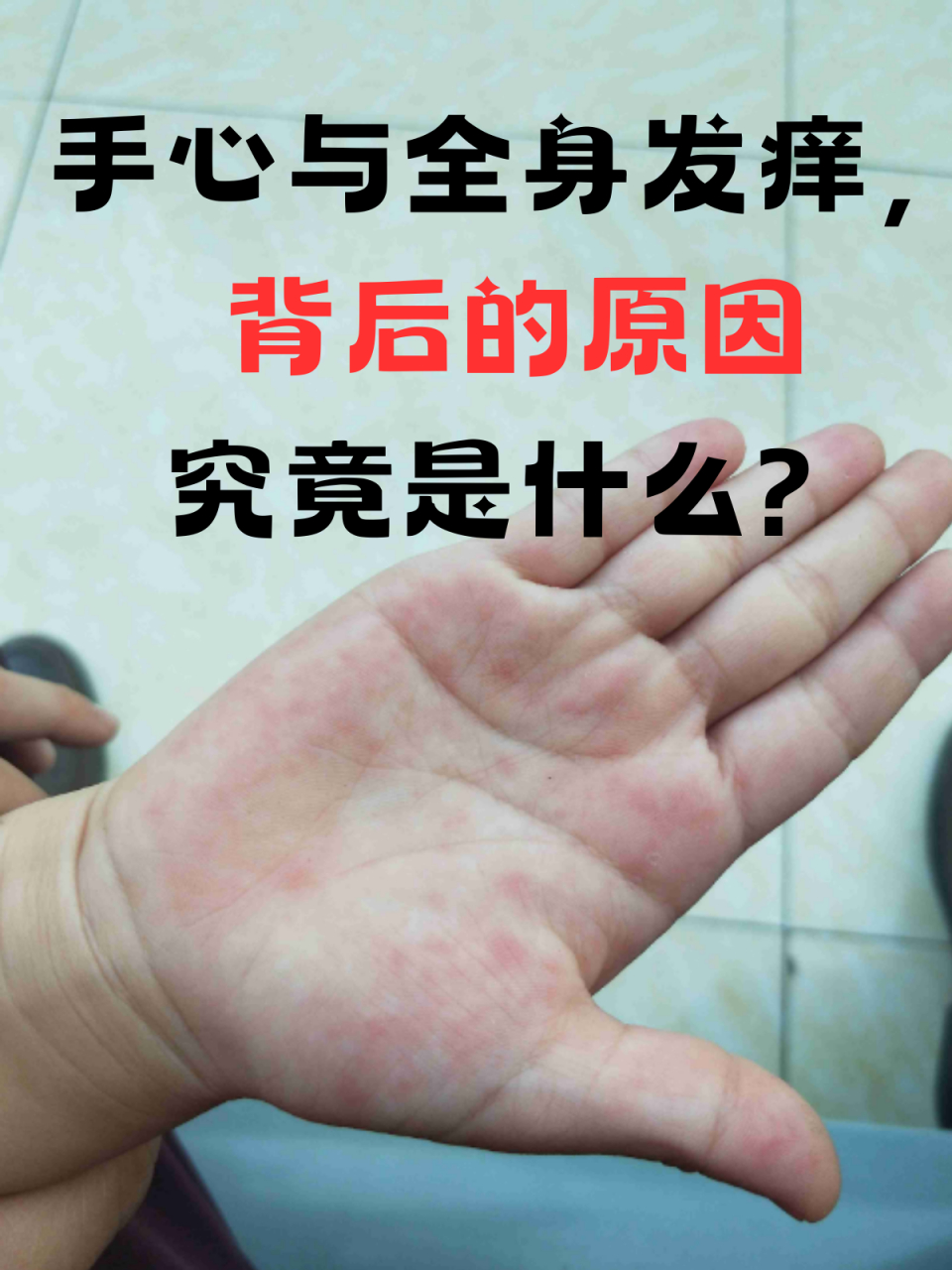 手心莫名其妙地开始发痒,紧接着身上其他部位也跟着痒起来,那种抓心