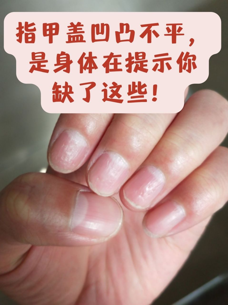 指甲盖凹凸不平,是身体在提示你缺了这些!
