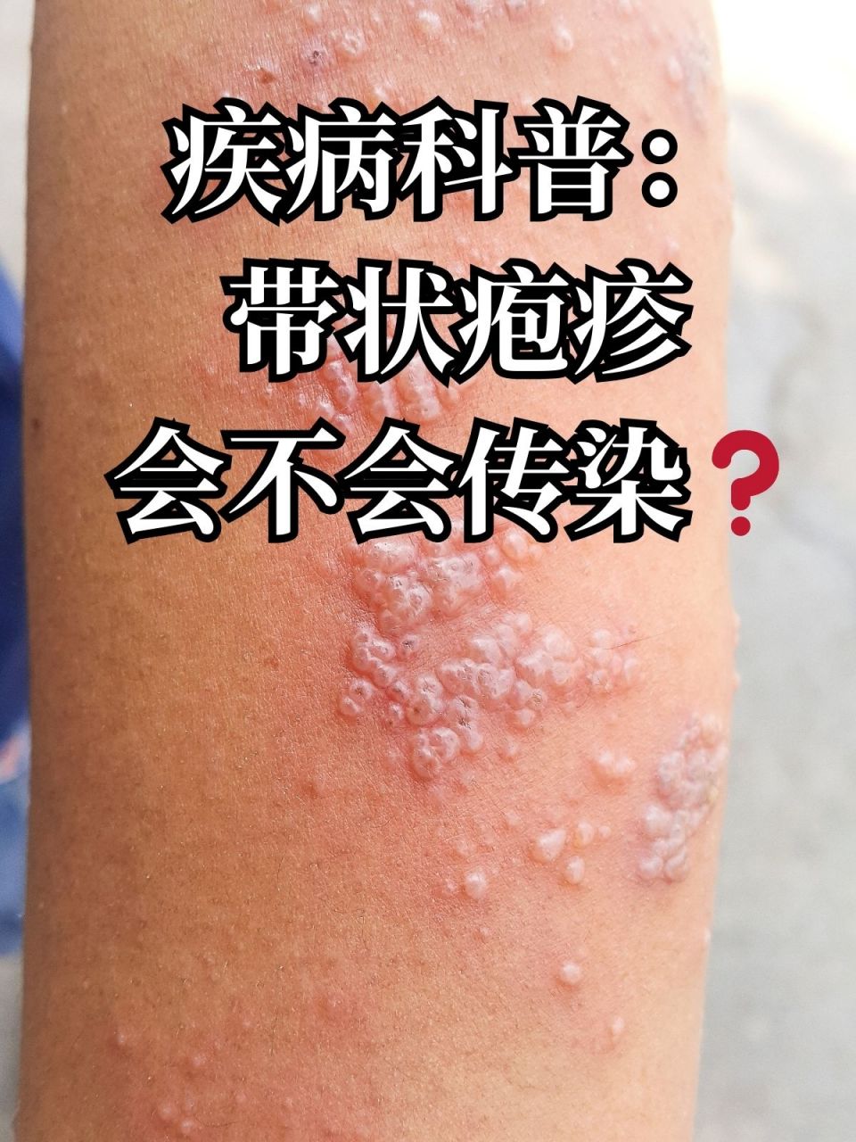 疾病科普:带状疱疹会不会传染71 很多人一听到带状疱疹就很紧张