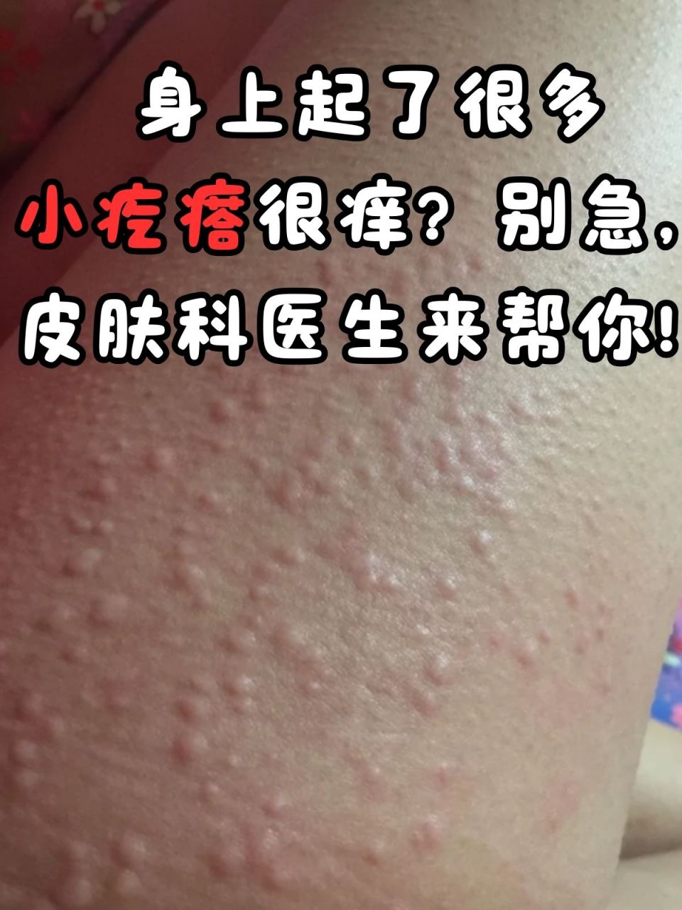 别急,皮肤科医生来帮你! 哎呀,身上突然起了很多小疙瘩,还痒得不行?