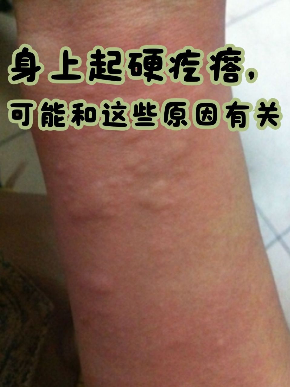 在我们的日常生活中,皮肤作为身体的第一道防线,偶尔会出现一些硬疙瘩