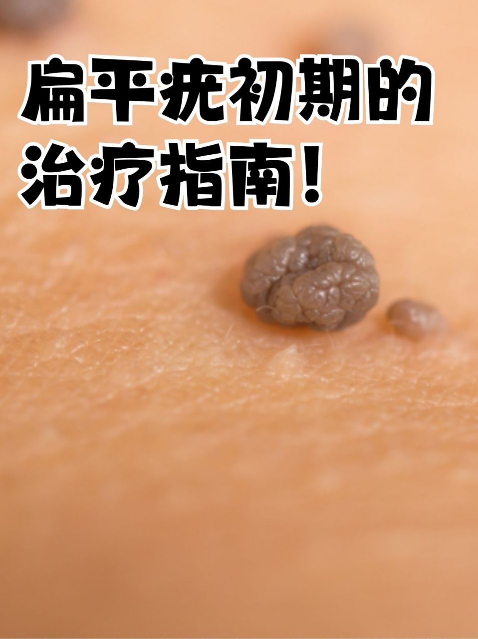 它由人乳头瘤病毒感染引起,好发于青少年,故又称之为青年扁平疣.