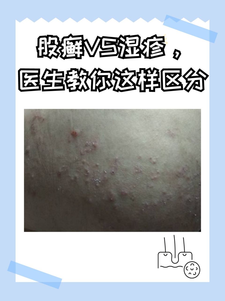 股癣vs湿疹,医生教你这样区分 股癣与湿疹是两种常见的皮肤问题,有些