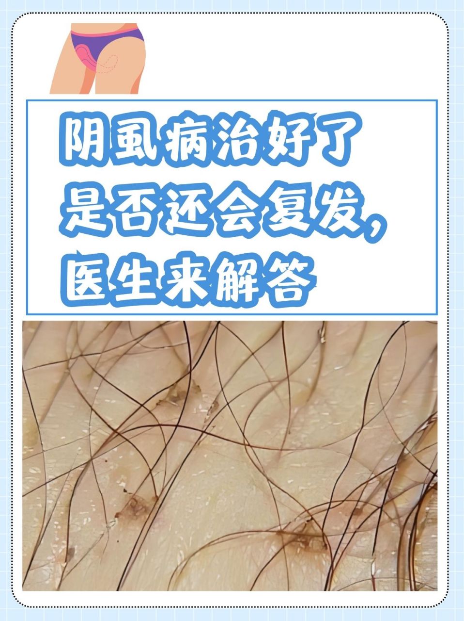 阴虱病治好了是否还会复发,医生来解答 随着社会卫生环境的提升,阴虱