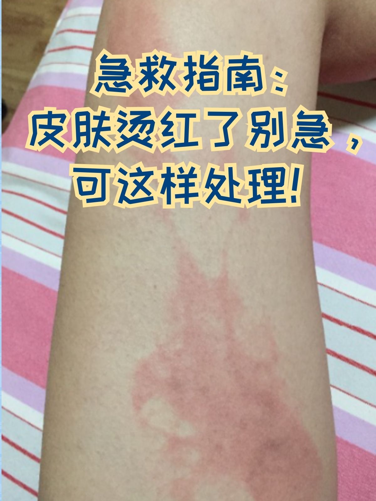 皮肤烫红真的是让人又疼又慌,那种灼烧感和红肿,想想都难受