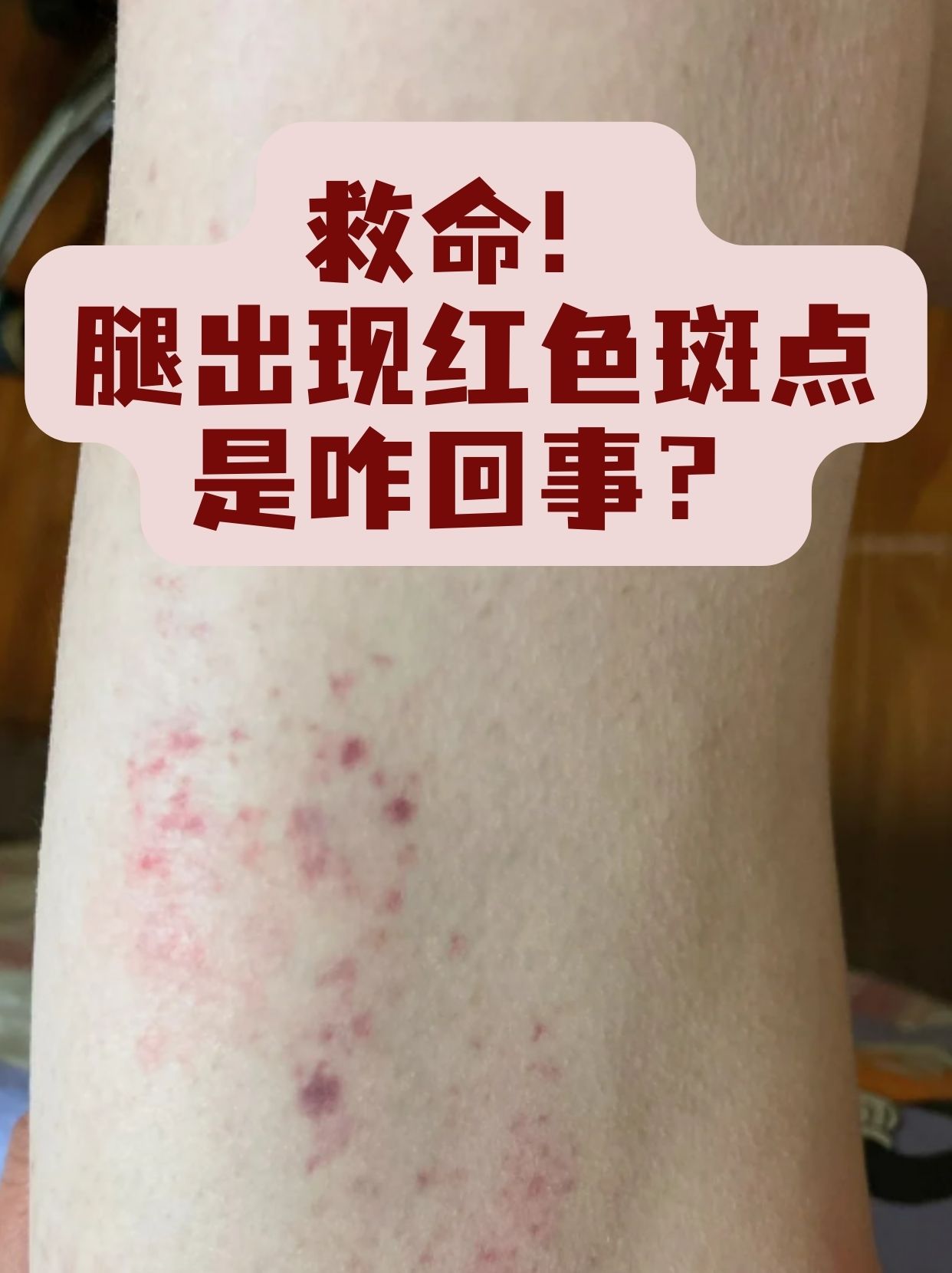 腿出现红色斑点是咋回事?