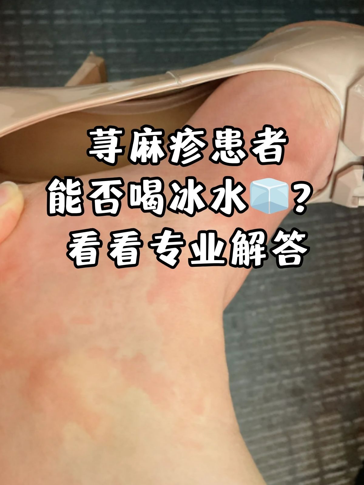 看看专业解答 荨麻疹这一常见的皮肤过敏反应,常常让患者感到困扰不已