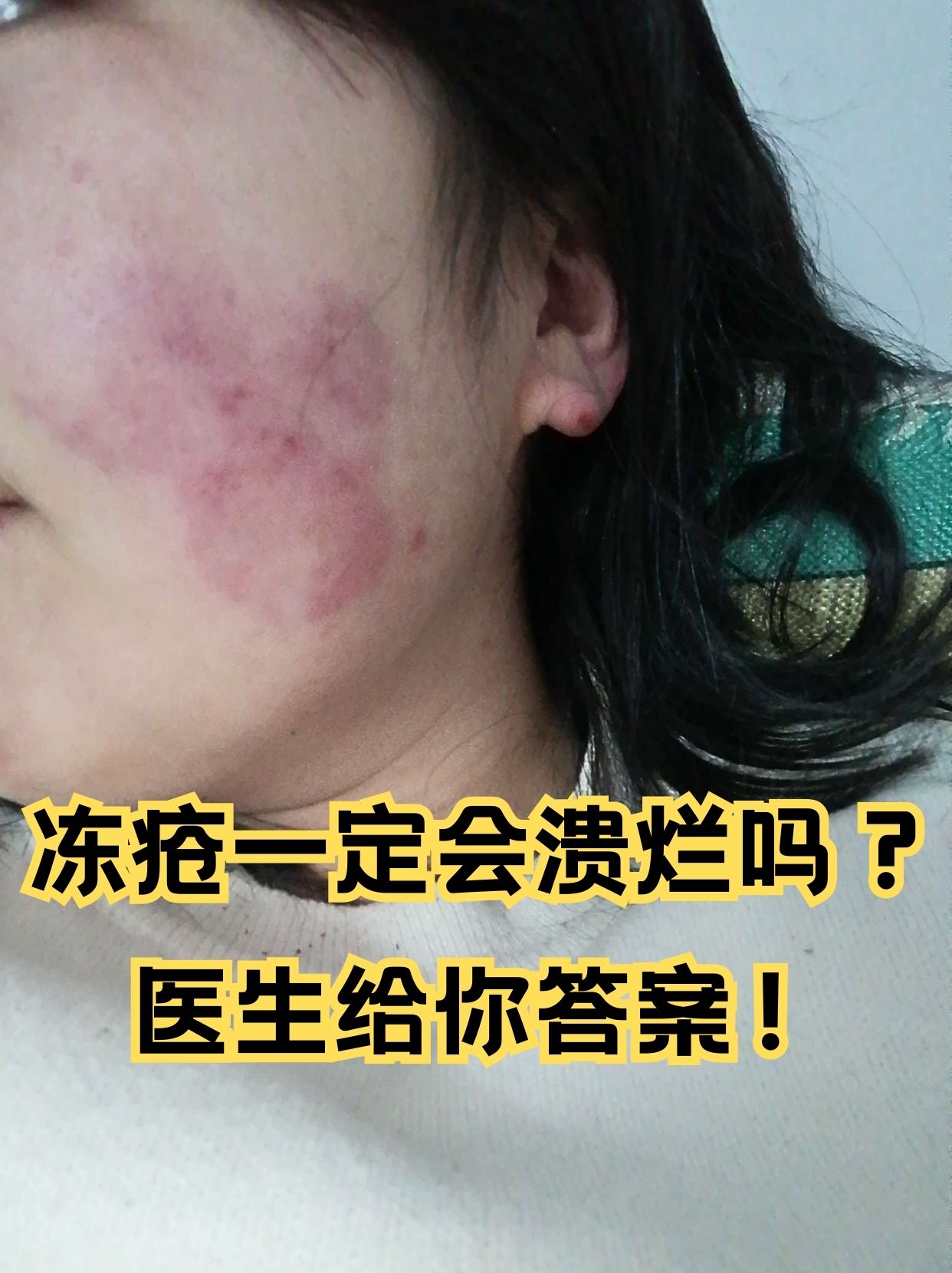 冻疮腐烂图片