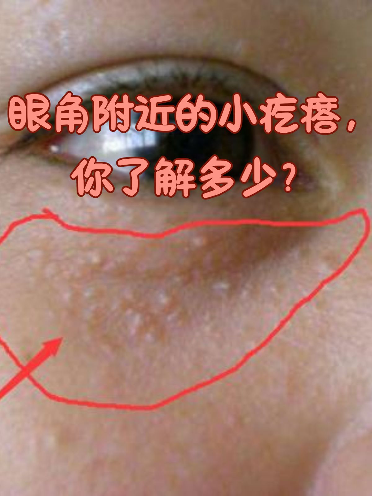 在照镜子的时候,你是否突然发现眼角附近冒出了一些小疙瘩?