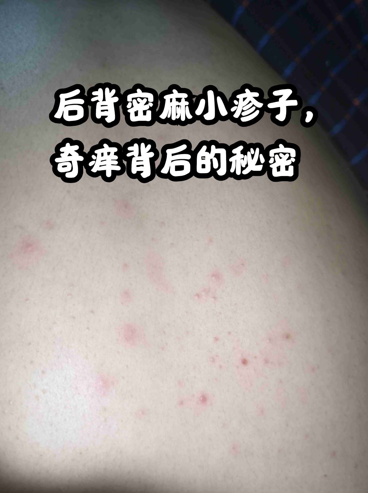 后背密麻小疹子,奇痒背后的秘密 在炎热的夏季或是换季之时,不少患者