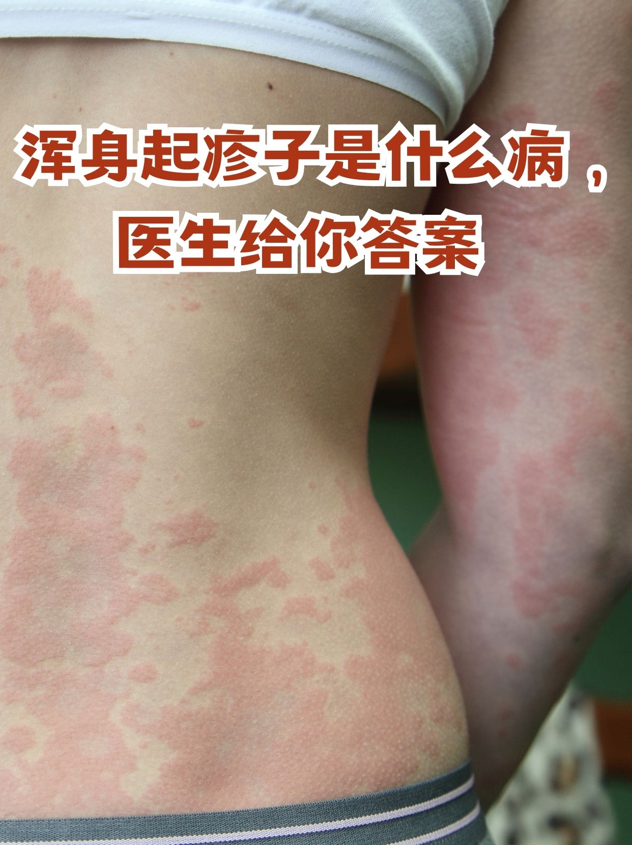 浑身起疹子是什么病,医生给你答案 浑身起疹子是一
