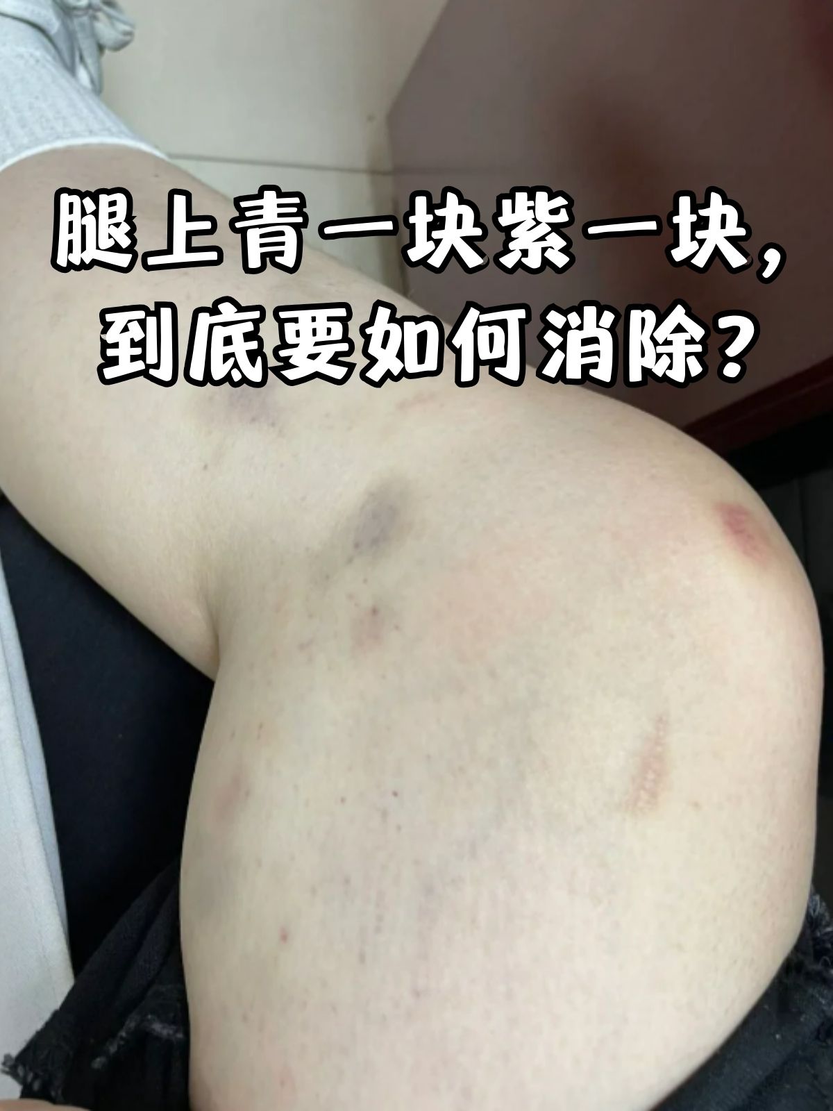 腿上青一块紫一块,到底要如何消除?