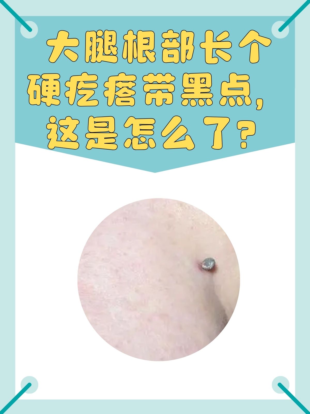 大腿根部有一个硬疙瘩图片