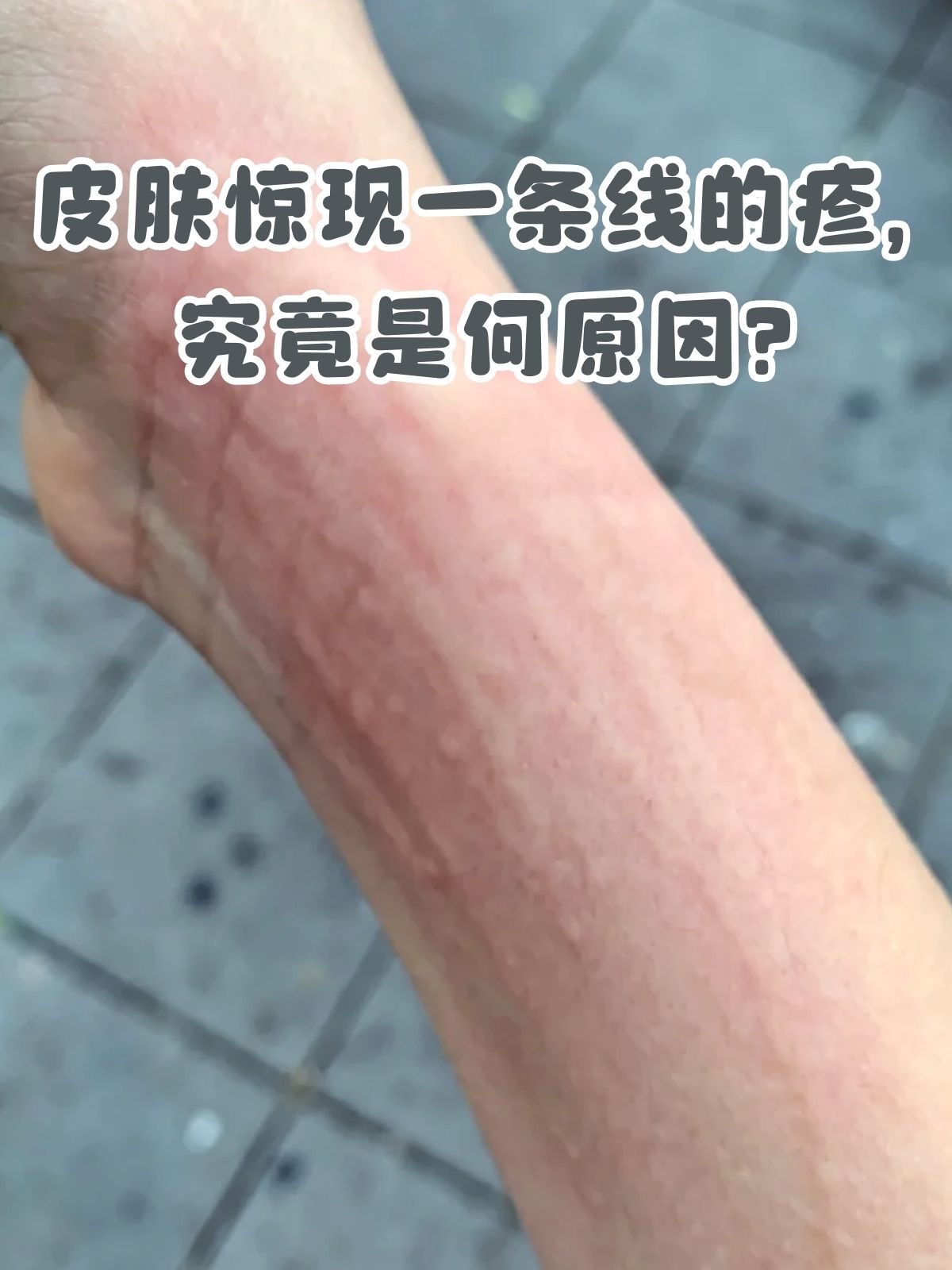 皮肤惊现一条线的疹,究竟是何原因?