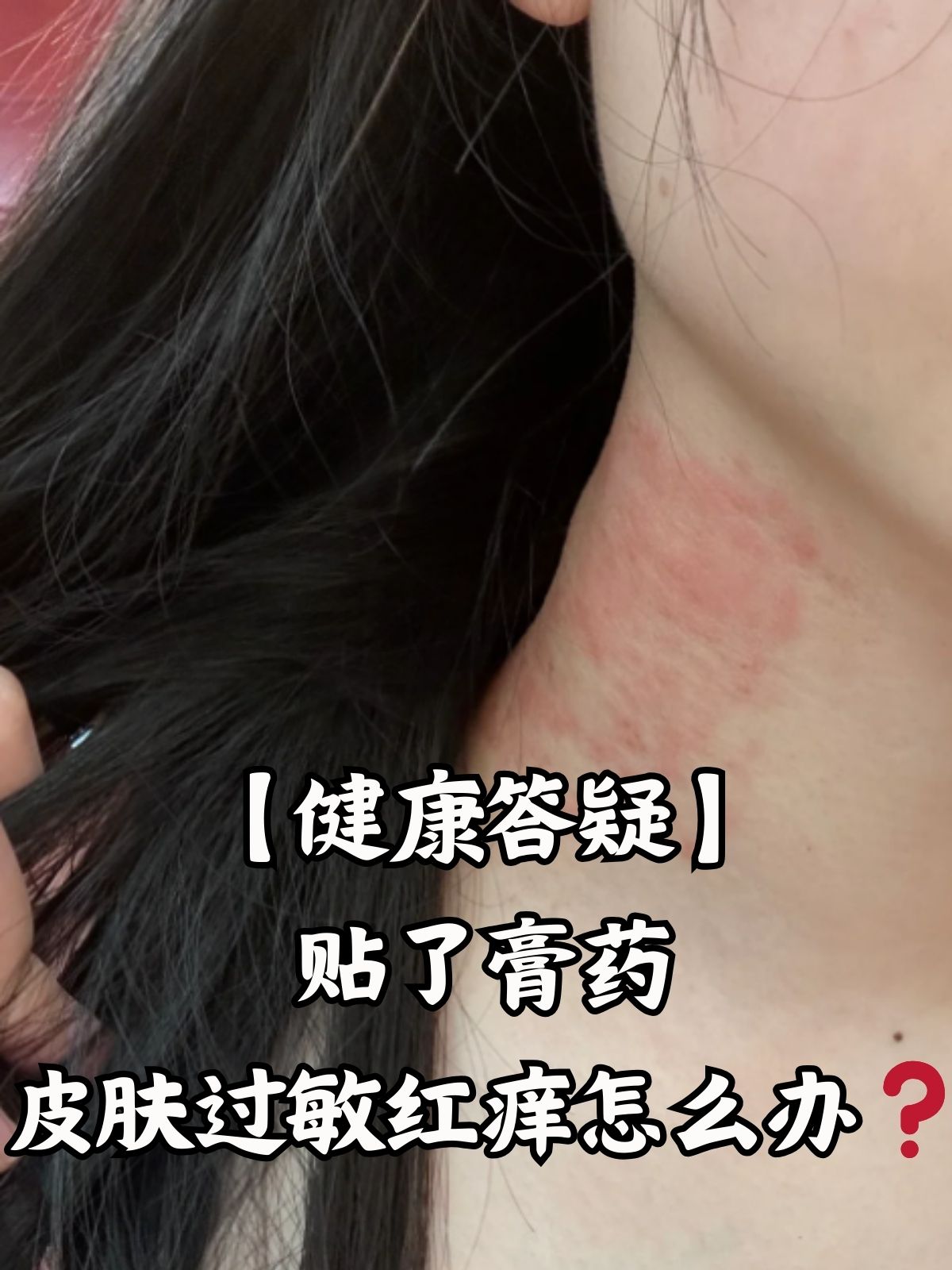 【健康答疑】贴了膏药皮肤过敏红痒怎么办 贴膏药后皮肤出现红痒,这